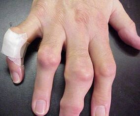 Τα δάχτυλα με παραμορφώσεις στις αρθρώσεις προκαλούν πόνο