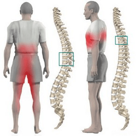 Πόνος στην πλάτη στη θωρακική οστεοχόνδρωση