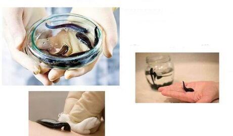 Hirudotherapy για την οστεοαρθρίτιδα
